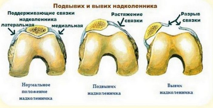 Травма колена - вывих наколенника