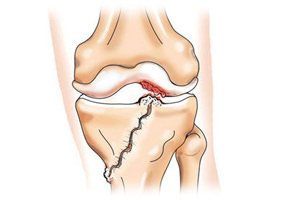 Изображение - Травма коленного сустава первая помощь vidy-zakrytyx-travm-kolena-simptomy-travm-kolennogo-sustava-6