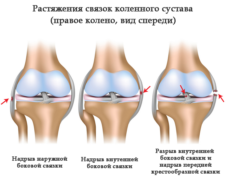 Ушиб коленного сустава