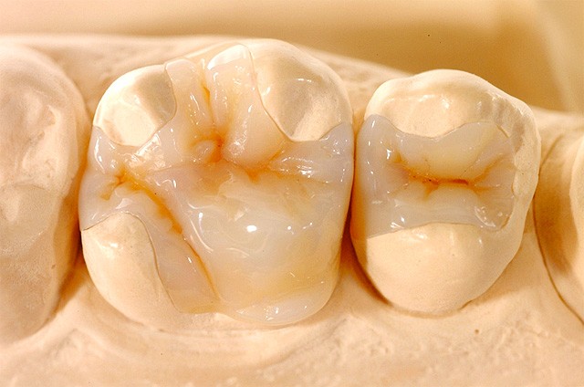 Микропротезирование зубов вкладками