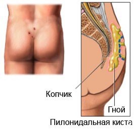 Воспаление пилонидальной кисты копчика и абсцесс