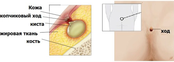 Эпителиальный копчиковый ход - причины и симптомы копчиковой кисты
