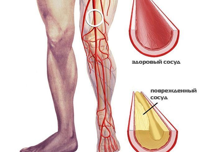 Поражение сосудов ноги, как причина жжения и зуда стопы