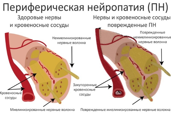 Периферическая нейропатия