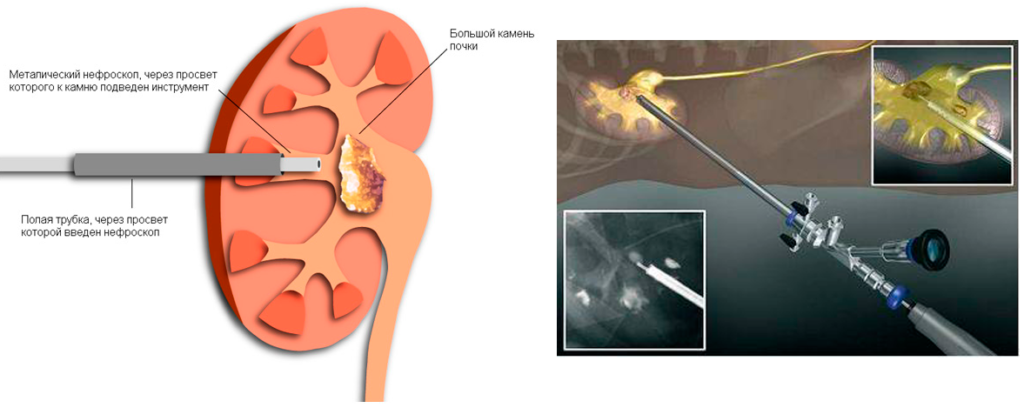 Транскутанная литотрипсия при мочекаменной болезни