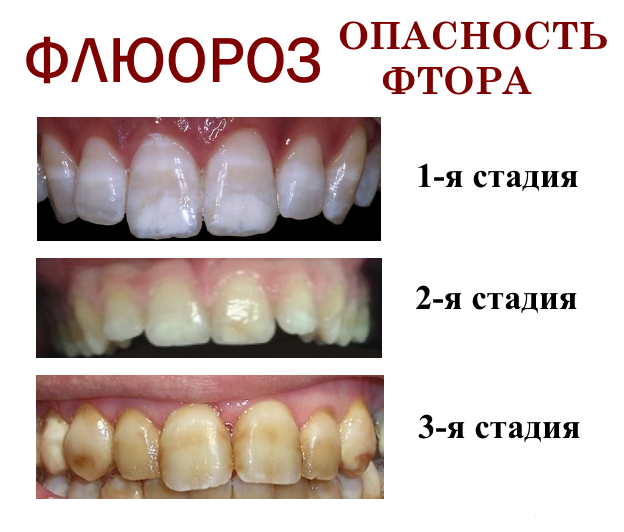 Опасность фтора - флюороз