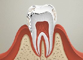 Флюороз зубов - причины и последствия