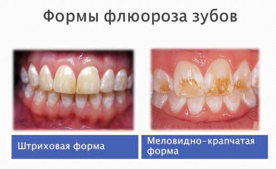 Формы флюороза зубов