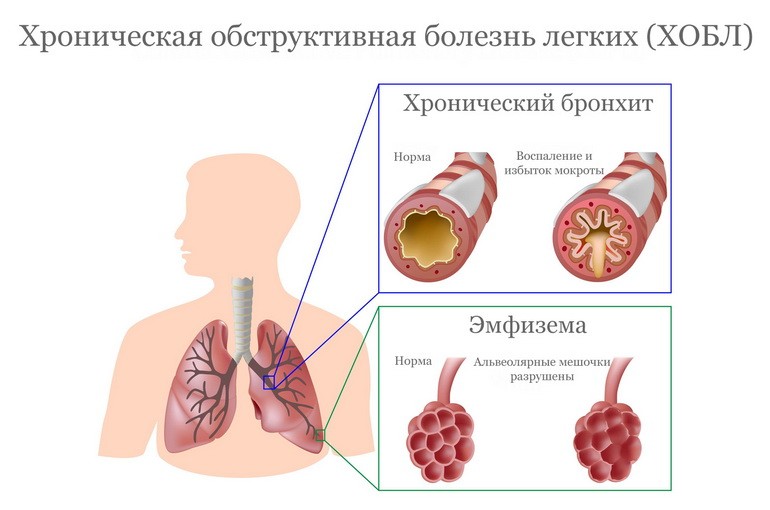 Симптомы ХОБЛ - как вовремя заметить хроническую обструктивную болезнь легких