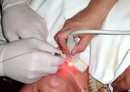 Операция на щитовидке лазером, удаление узлов