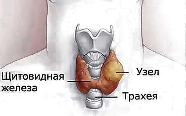 Удаление узлов щитовидки лазером