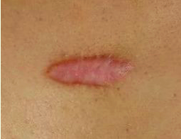 Гипертрофические рубцы после ожогов на лице thumbnail