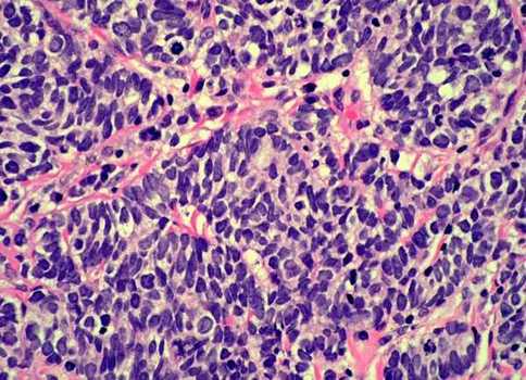 Мелкоклеточный овсяноклеточный рак