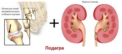 Почки - мишень при подагре