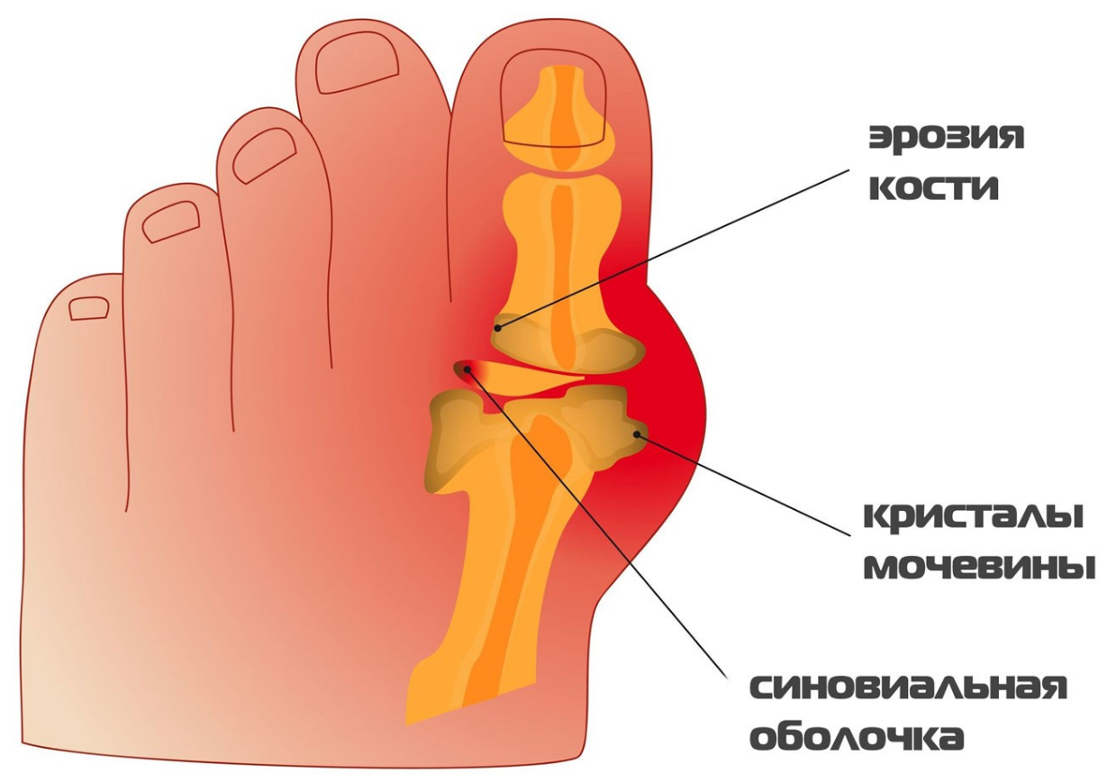 Причины подагры - возникновение подагрических тофусов
