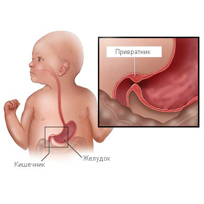 Врожденный пилоростеноз - причины и симптомы