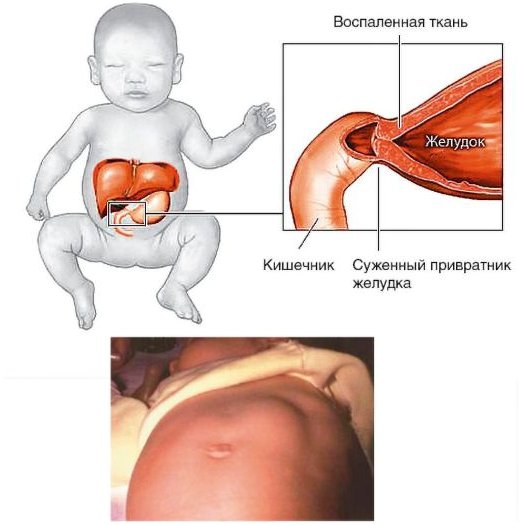 пилоростеноз,пилоростеноз у новорожденных,пилоростеноз у детей,врожденный пилоростеноз,пилоростеноз у новорожденных симптоматика,пилоростеноз диагностика,пилоростеноз симптомы,пилоростеноз у новорожденных диагностика,пилоростеноз у новорожденных симптоматика диагностика,пилороспазм и пилоростеноз,гипертрофический пилоростеноз,врожденный гипертрофический пилоростеноз,пилоростеноз возраст,детская хирургия
