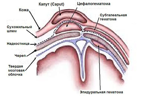 Расположение родовой гематомы - схема