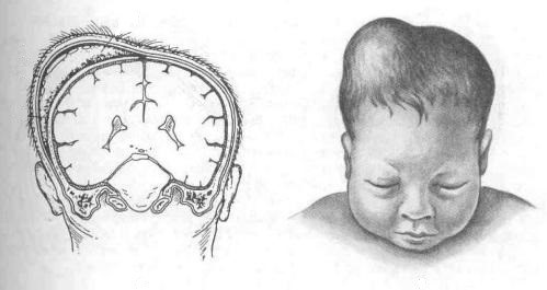 Родовая гематома на головке новорожденного