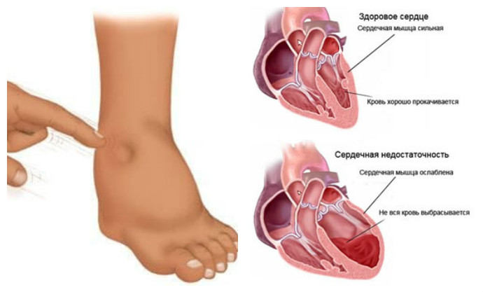Типичные отеки ног при сердечной недостаточности