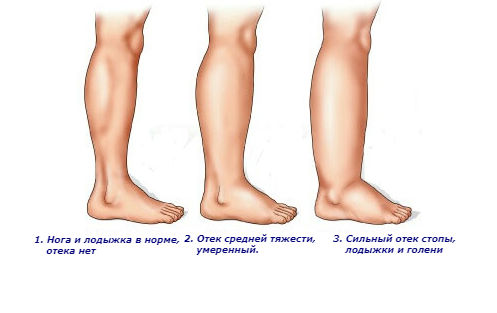 Степени отеков ног