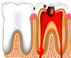 Когда зуб пульсирует и стреляет – как лечить пульпит, и есть ли шанс сохранить зубы?
