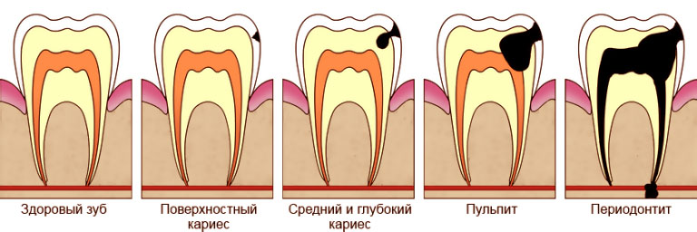 Диагностика и лечение пульпита