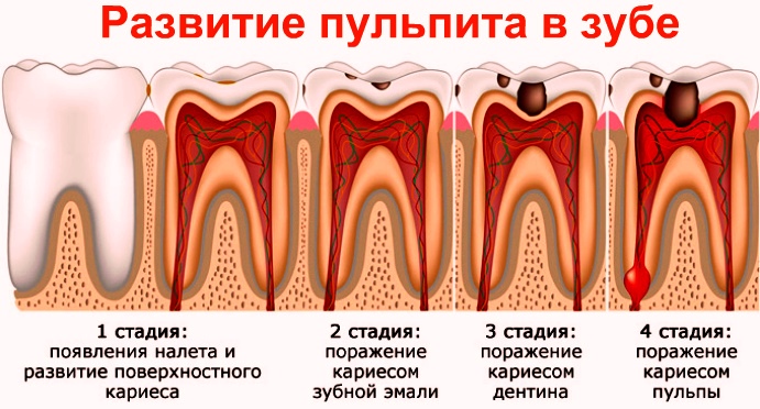 Причины пульпита