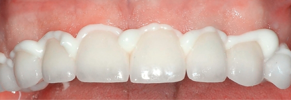 Стеклоиономерный цемент для фиксации коронок и несъемных зубных протезов
