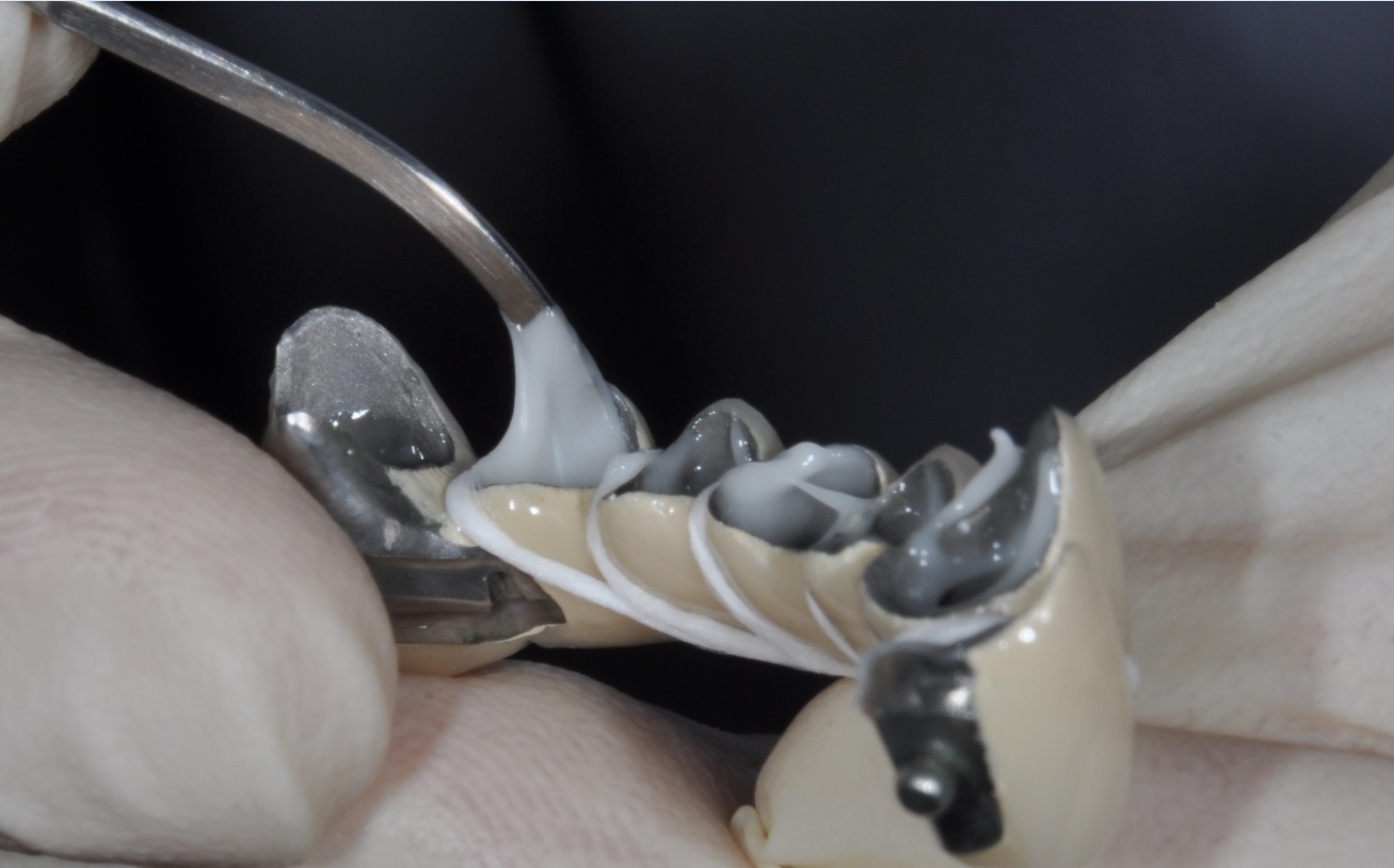 Композитный цемент для фиксации коронок и зубных протезов