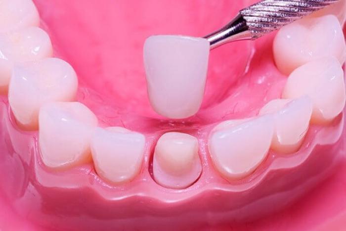 Виды стоматологических цементов для фиксации несъемных зубных протезов, коронок