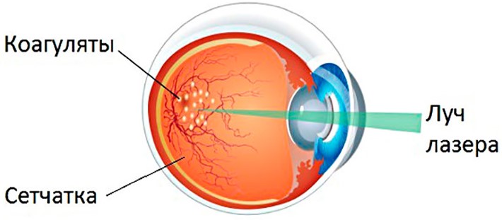Лазерная коагуляция сетчатки глаза - показания и противопоказания