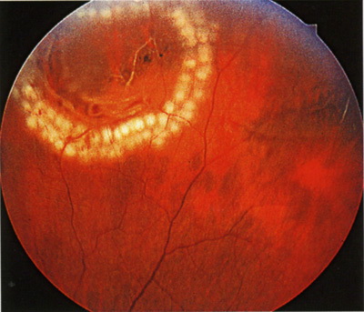 Барьерная лазерная коагуляция сетчатки глаза
