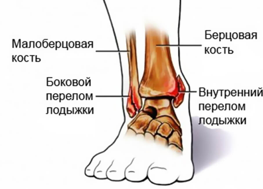 Виды переломов голеностопа - симптомы