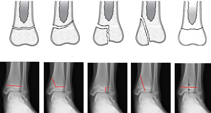 Виды переломов голеностопа