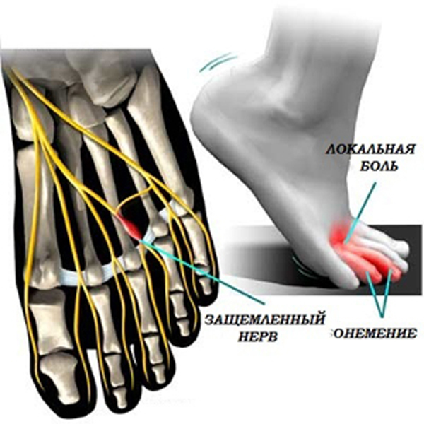 неврома мортона болит вся нога thumbnail