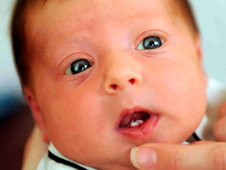 Зубы у ребенка при рождении или сразу после - причины и последствия