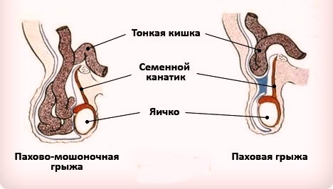 Методики лечения паховых грыж у детей thumbnail