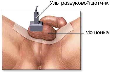 УЗИ мошонки при водянке яичка у мальчиков