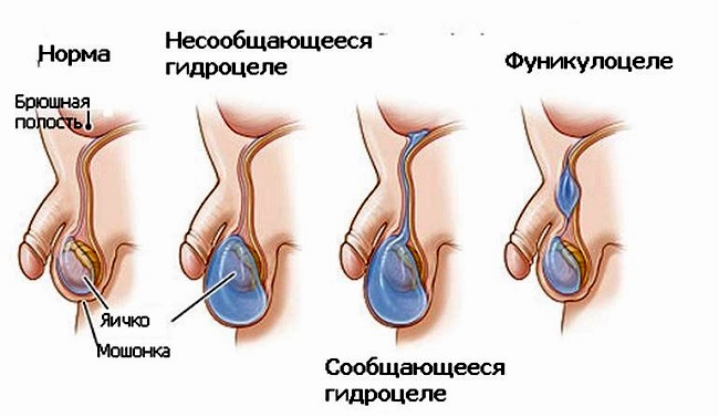 Гидроцеле у мальчиков - причины  водянки оболочек яичка и эффективное лечение
