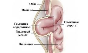 Грыжа в паху у новорожденных и детей старше