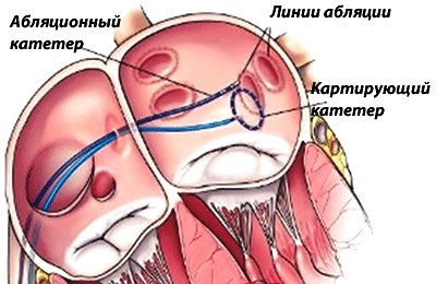 Катетерная абляция