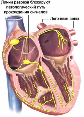 Лабиринт (операция на сердце)