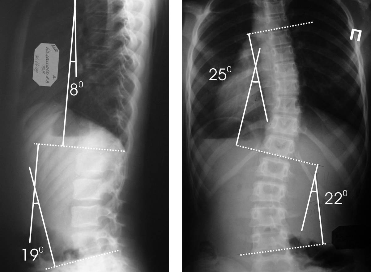 Пример: рентгенография при сколиозе - углы сколиотической деформации позвоночного столба
