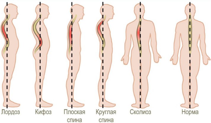 Виды сколиотической деформации позвоночника