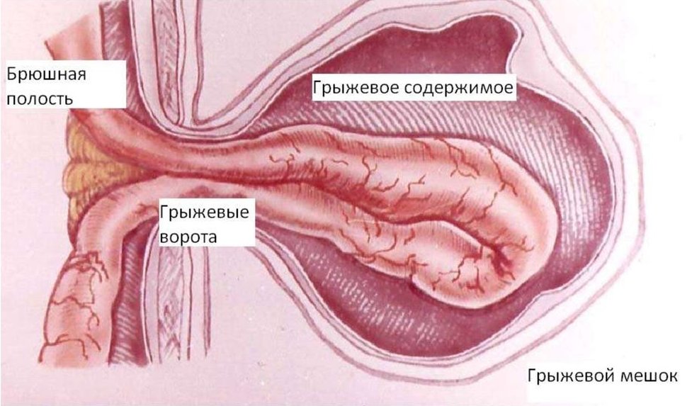 Строение пупочной грыжи