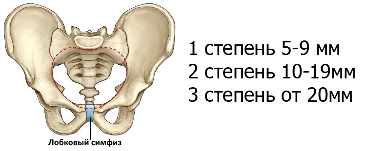 Степени симфизита при беременности