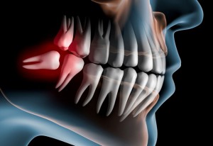 Бывает ли рак зуба - причины и симптомы