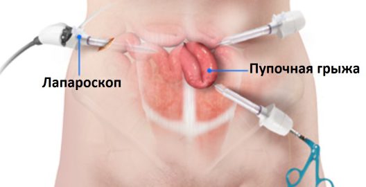 Лапароскопия у детей раннего возраста. Лапароскопическая пиелопластика у детей раннего возраста. Вот почему хирурги детской практики, когда вводят инструменты, применяют небольшие хитрости