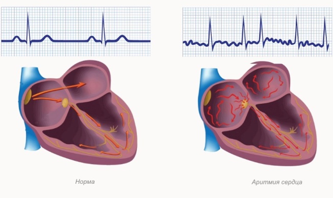 Виды аритмий сердца у детей
